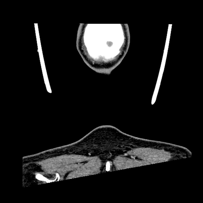 Anaplastic thyroid carcinoma (Radiopaedia 79087-92034 A 115).jpg