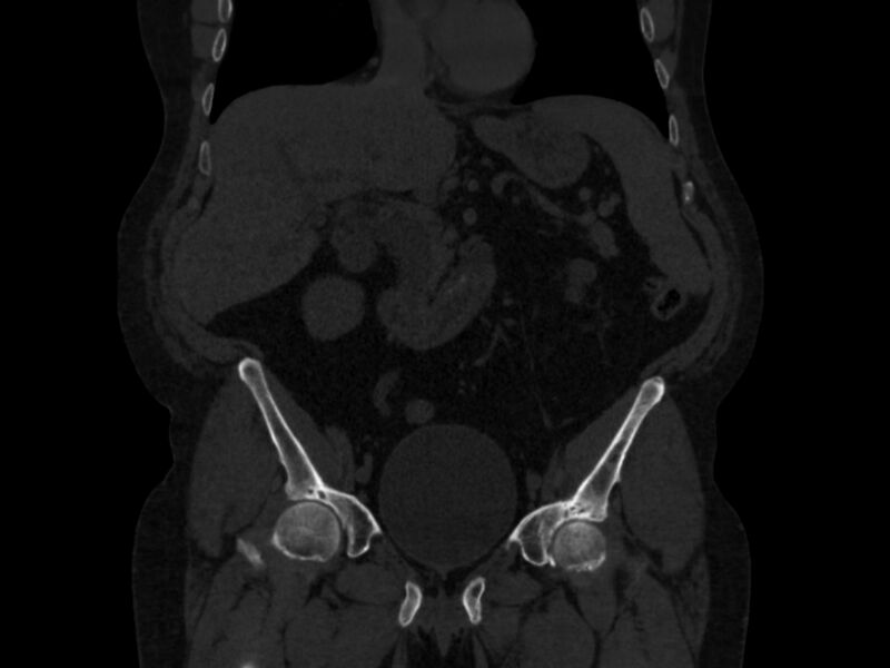 File:Ankylosing spondylitis (Radiopaedia 44609-48357 Coronal bone window 16).jpg