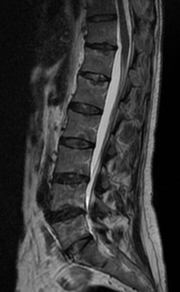 File:Ankylosing spondylitis - Andersson lesion (Radiopaedia 81878-95838 Sagittal T2 6).jpg