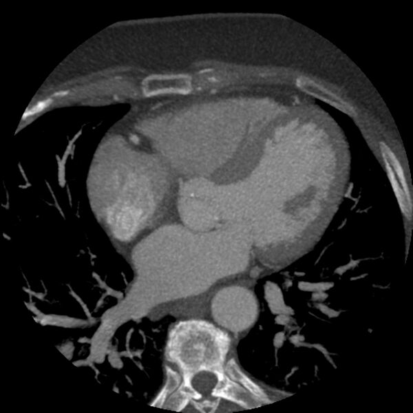 File:Anomalous origin of left circumflex artery from right coronary sinus (Radiopaedia 72563-83117 A 31).jpg