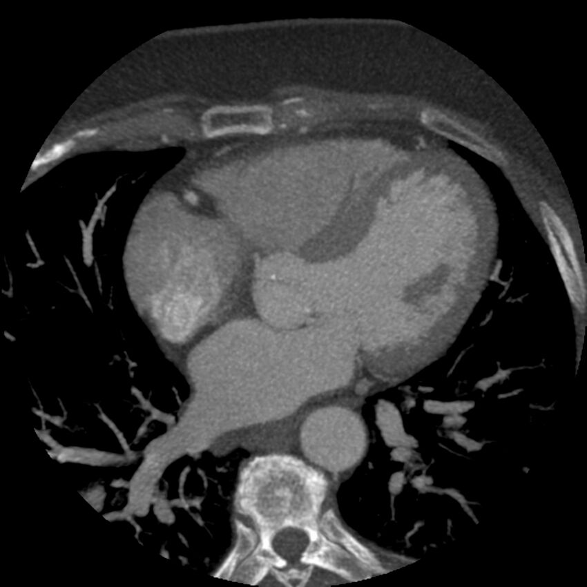 Anomalous origin of left circumflex artery from right coronary sinus (Radiopaedia 72563-83117 A 31).jpg