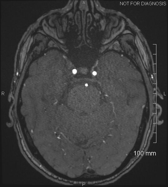 File:Anterior cerebral artery aneurysm (Radiopaedia 80683-94127 Axial MRA 75).jpg