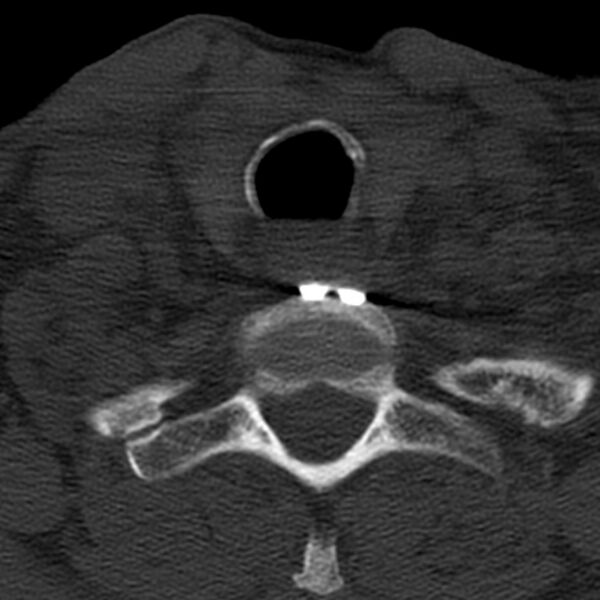 File:Anterior cervical postdiscectomy arthrodesis (Radiopaedia 32678-33646 Axial bone window 64).jpg