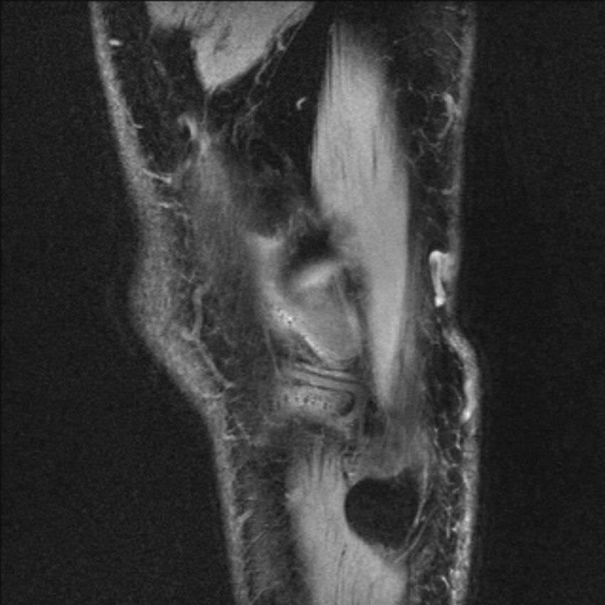 Anterior cruciate ligament mucoid degeneration (Radiopaedia 68400-77933 Sagittal 2).jpg