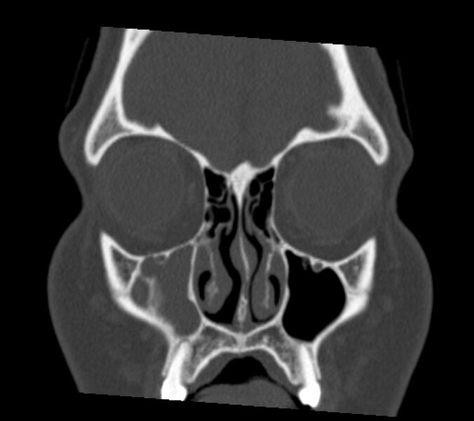 File:Antrochoanal polyp (Radiopaedia 21894-21868 Coronal bone window 8).jpg