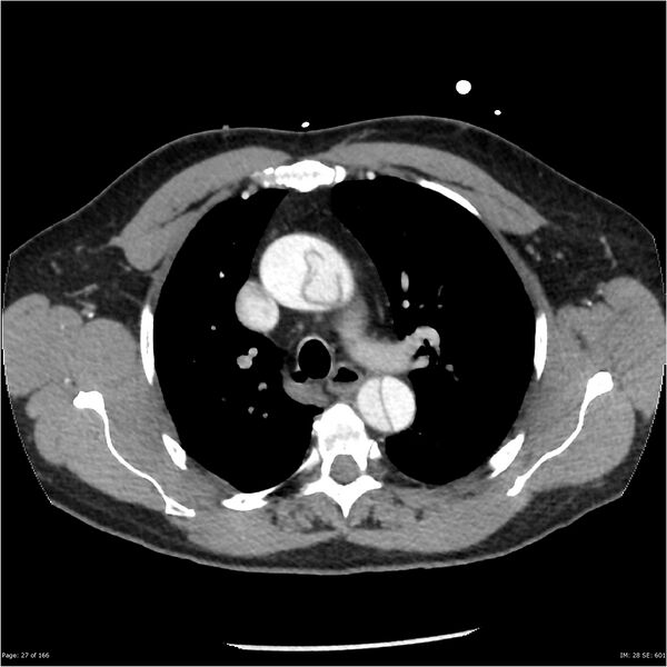 File:Aortic dissection- Stanford A (Radiopaedia 37759-39664 A 18).jpg