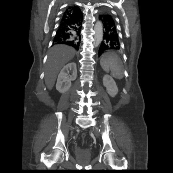 File:Aortic dissection (Radiopaedia 28802-29105 B 29).jpg