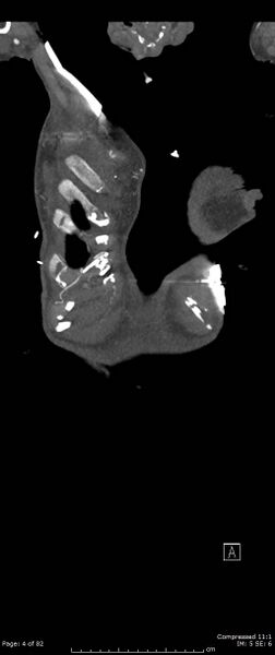 File:Aortic dissection with extension into aortic arch branches (Radiopaedia 64402-73204 A 4).jpg