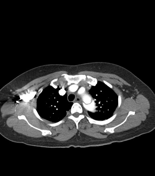 File:Aortic dissection with renal ischemia (Radiopaedia 76573-88338 A 11).jpg