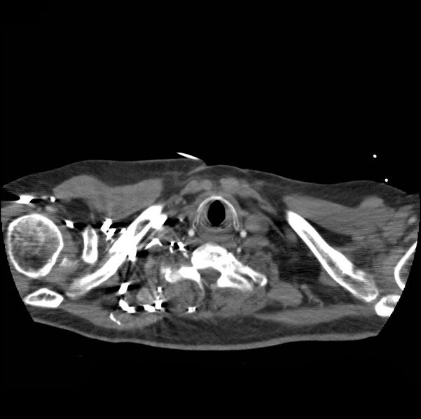 File:Aortic dissection with rupture into pericardium (Radiopaedia 12384-12647 A 3).jpg