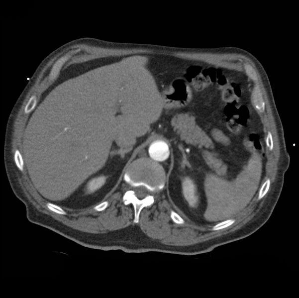 File:Aortic dissection with rupture into pericardium (Radiopaedia 12384-12647 A 53).jpg