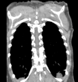 Aortic valve non-coronary cusp thrombus (Radiopaedia 55661-62189 C 67).png