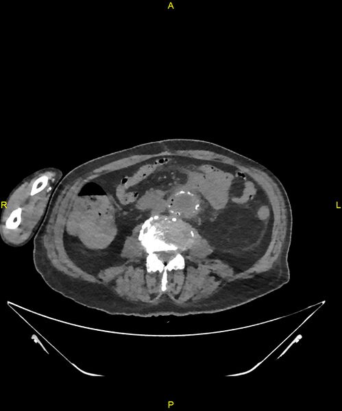 File:Aortoenteric fistula (Radiopaedia 84308-99603 Axial non-contrast 200).jpg