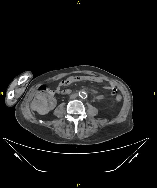 File:Aortoenteric fistula (Radiopaedia 84308-99603 Axial non-contrast 219).jpg