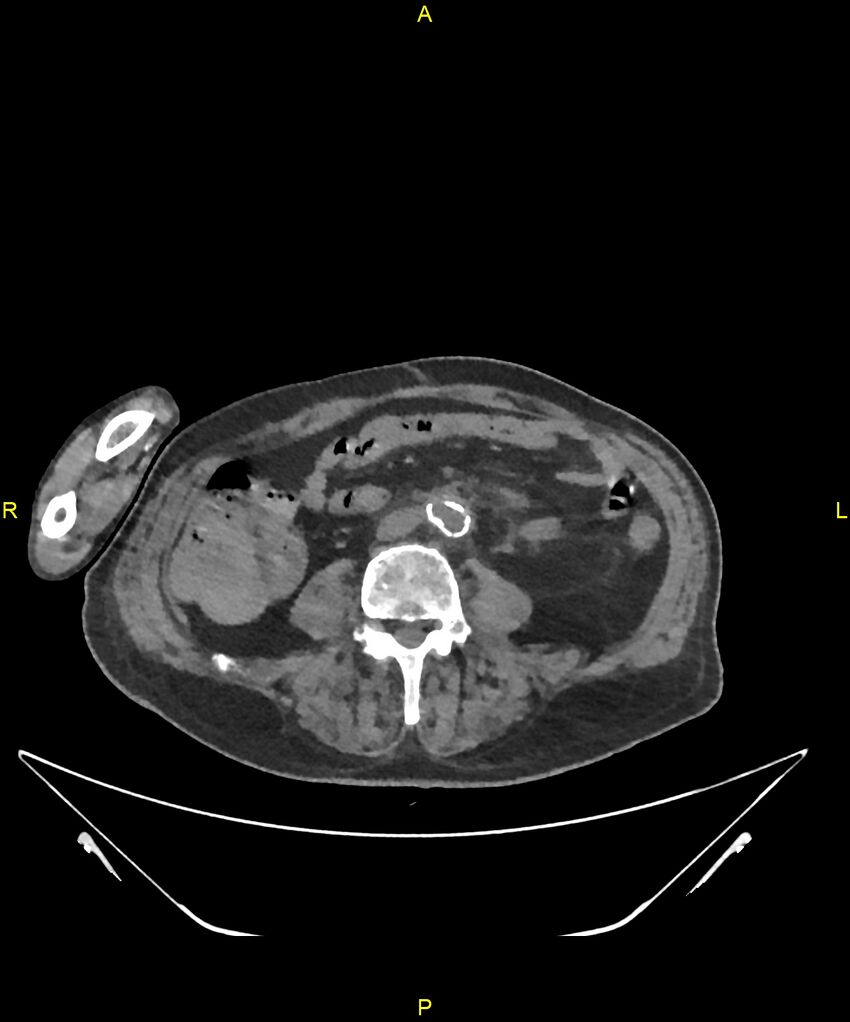 Aortoenteric fistula (Radiopaedia 84308-99603 Axial non-contrast 219).jpg