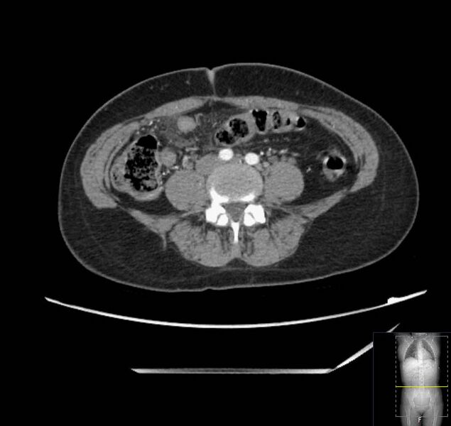 File:Appendicitis (CT angiogram) (Radiopaedia 154713-127660 Axial 41).jpg