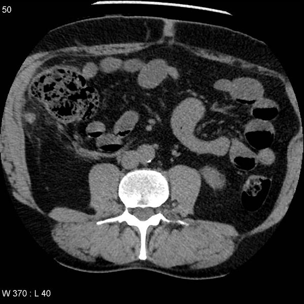 File:Appendicitis (Radiopaedia 12510-12733 Axial non-contrast 17).jpg