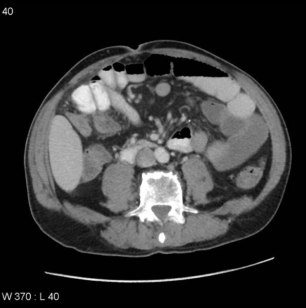 File:Appendicitis (Radiopaedia 27446-27642 A 19).jpg