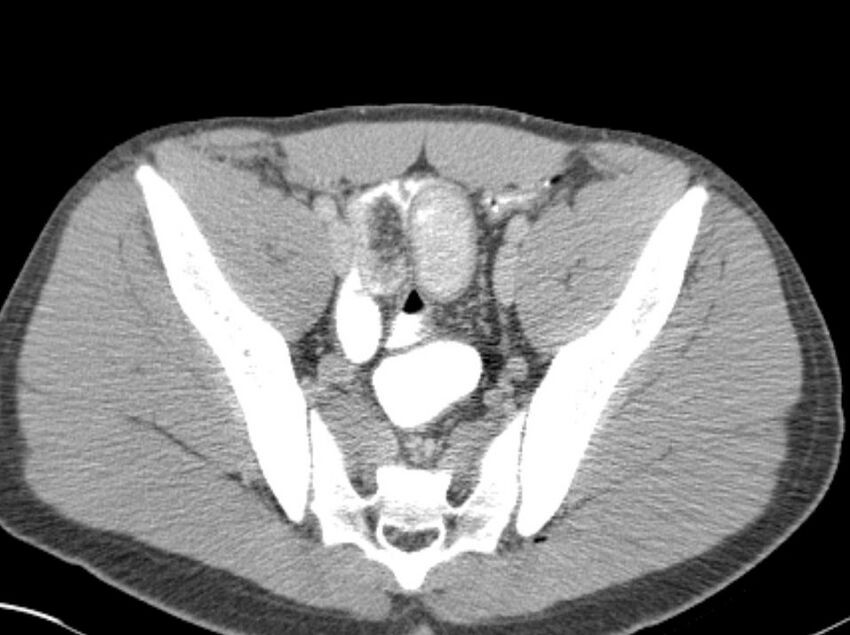 Appendicitis and incidental foregut duplication cyst (Radiopaedia 52962-58916 A 81).jpg