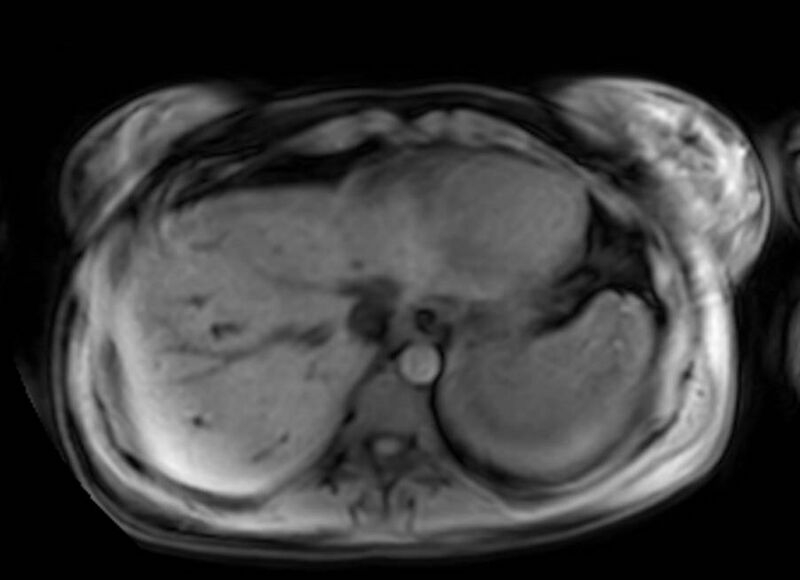 File:Appendicitis in gravida (MRI) (Radiopaedia 89433-106395 Axial DIXON 6).jpg