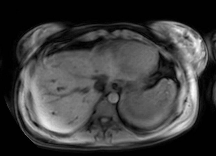 Appendicitis in gravida (MRI) (Radiopaedia 89433-106395 Axial DIXON 6).jpg