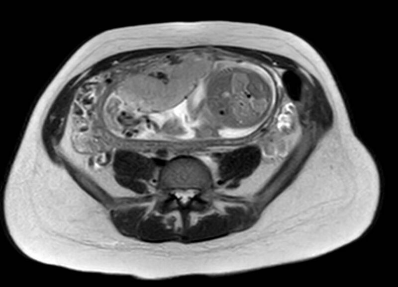 File:Appendicitis in gravida (MRI) (Radiopaedia 89433-106395 Axial T2 45).jpg