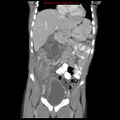Appendicitis with phlegmon (Radiopaedia 9358-10046 B 27).jpg