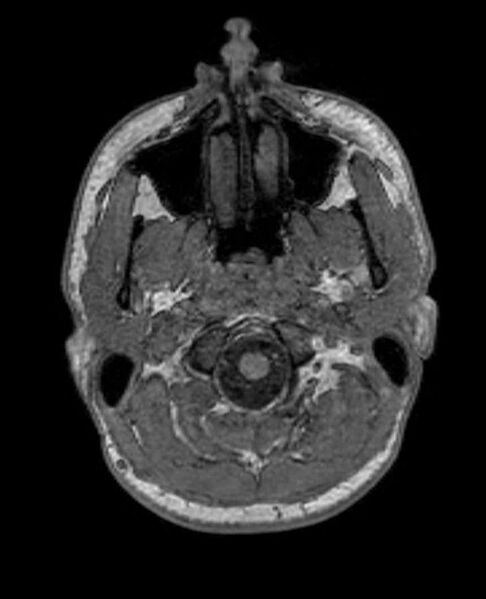 File:Arachnoid cyst- extremely large (Radiopaedia 68741-78451 Axial T1 7).jpg