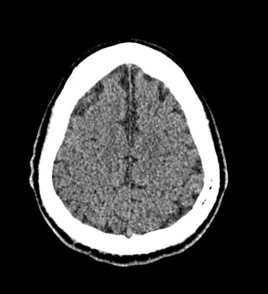 File:Arachnoid cyst of the ambient cistern (Radiopaedia 81301-94986 Axial non-contrast 57).jpg