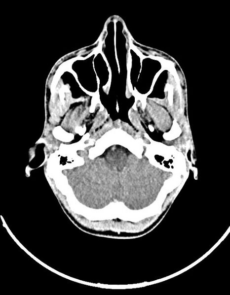 File:Arrow injury to the brain (Radiopaedia 72101-82607 Axial non-contrast 53).jpg