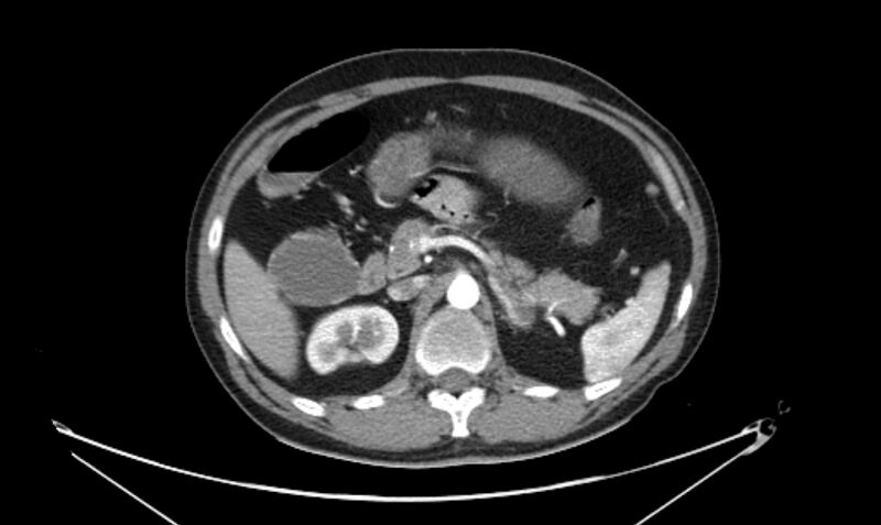 File:Arterial occlusive mesenteric ischemia (Radiopaedia 84641-100060 A 49).jpg