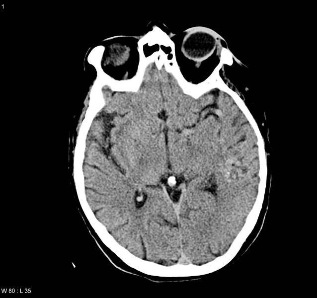 File:Arteriovenous malformation - cerebral (Radiopaedia 8172-9020 Axial non-contrast 9).jpg