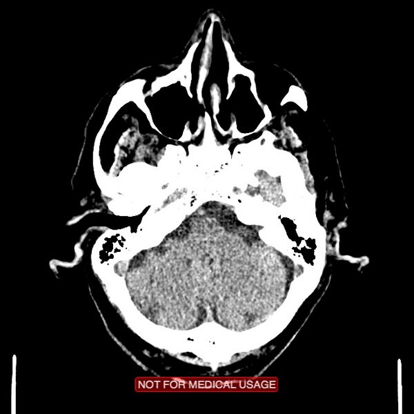 File:Artery of Percheron infarction (Radiopaedia 28679-28967 Axial non-contrast 26).jpg