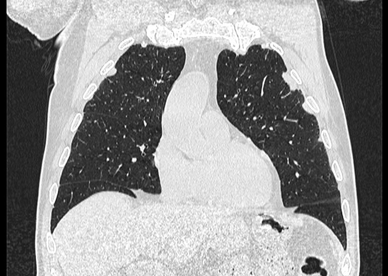 File:Asbestos pleural placques (Radiopaedia 57905-64872 Coronal lung window 85).jpg