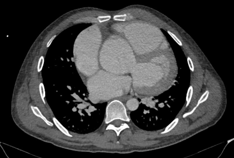 File:Ascending aortic aneurysm (Radiopaedia 86279-102297 C 37).jpg