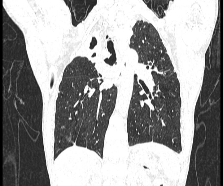 File:Aspergillomas (Radiopaedia 66779-76110 Coronal lung window 13).jpg
