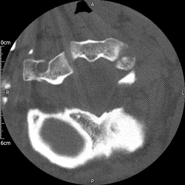 File:Atlas fracture with Currarino type A congenital defect (Radiopaedia 71747-82144 Axial bone window 41).jpg