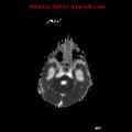 Atypical teratoid rhabdoid tumor (Radiopaedia 10712-11183 Axial ADC 13).jpg