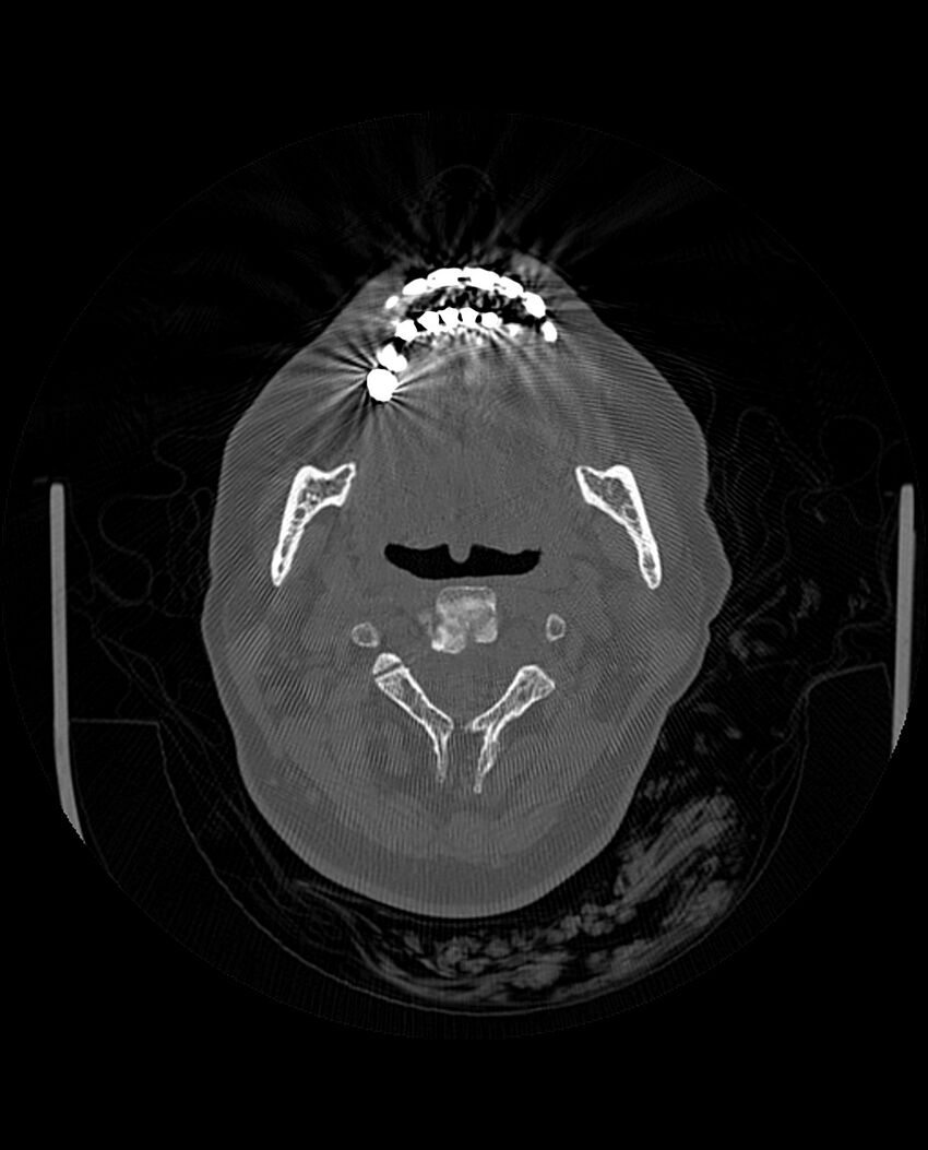 Automastoidectomy with labyrinthine fistula (Radiopaedia 84143-99411 Axial non-contrast 2).jpg