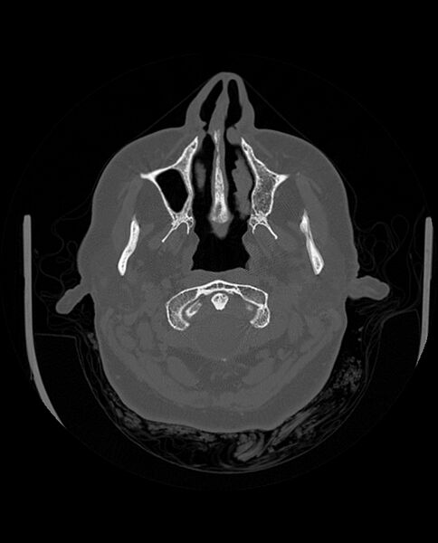 File:Automastoidectomy with labyrinthine fistula (Radiopaedia 84143-99411 Axial non-contrast 45).jpg