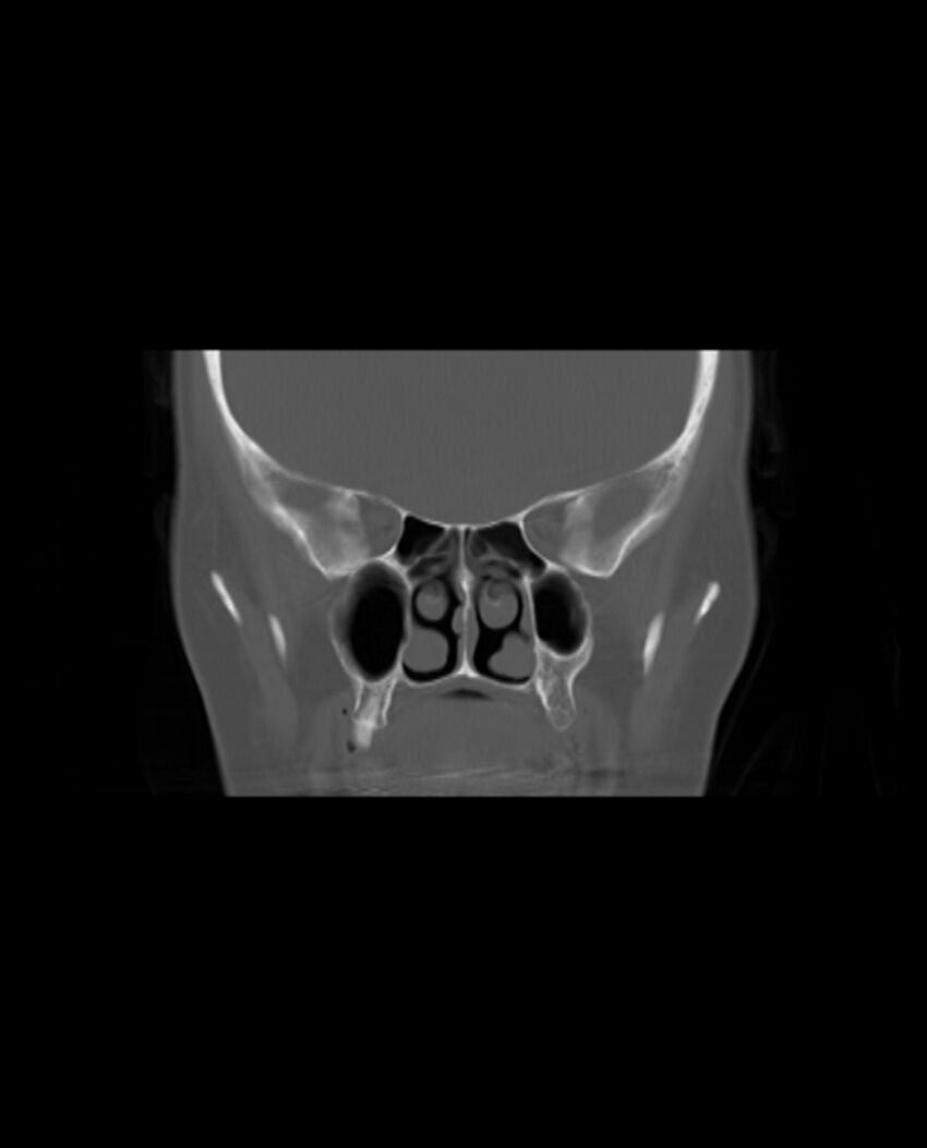 Automastoidectomy with labyrinthine fistula (Radiopaedia 84143-99411 Coronal non-contrast 46).jpg