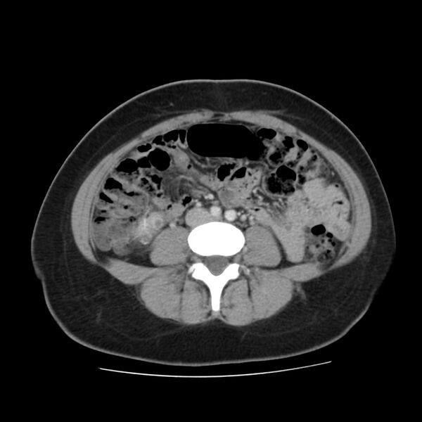 File:Autosomal dominant polycystic kidney disease (Radiopaedia 23061-23093 C 41).jpg