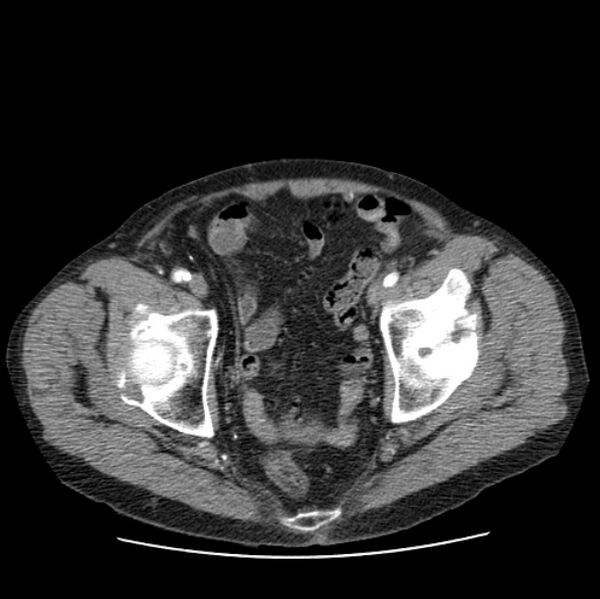 File:Autosomal dominant polycystic kidney disease (Radiopaedia 27851-28094 B 111).jpg