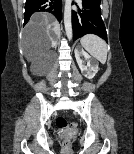 File:Autosomal dominant polycystic kidney disease (Radiopaedia 57124-64017 B 53).jpg