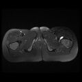 Avascular necrosis of the hip (Radiopaedia 29563-30067 Axial T2 fat sat 16).jpg