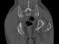 Avascular necrosis of the left hip (Radiopaedia 75068-86125 Coronal bone window 83).jpg