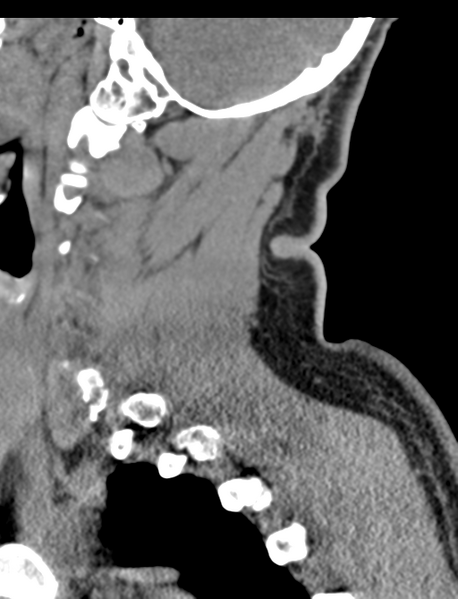 File:Axis peg fracture (type 3) and atlas lateral mass (type 4) fracture (Radiopaedia 37474-39324 D 20).png