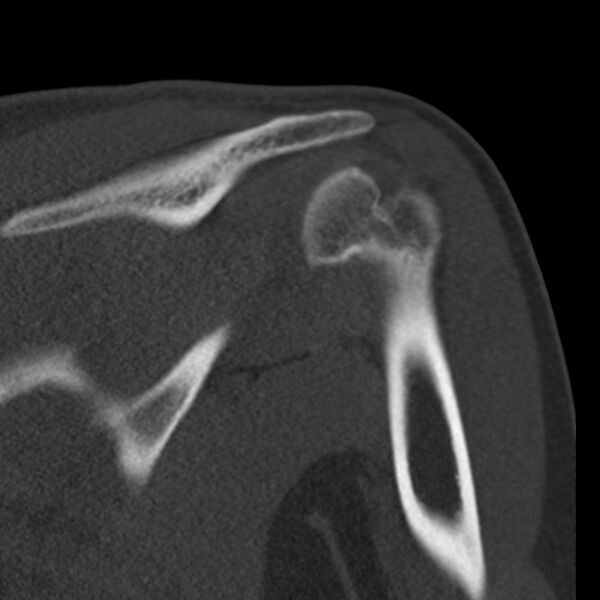 File:Bankart lesion (Radiopaedia 22771-22798 Coronal bone window 30).jpg