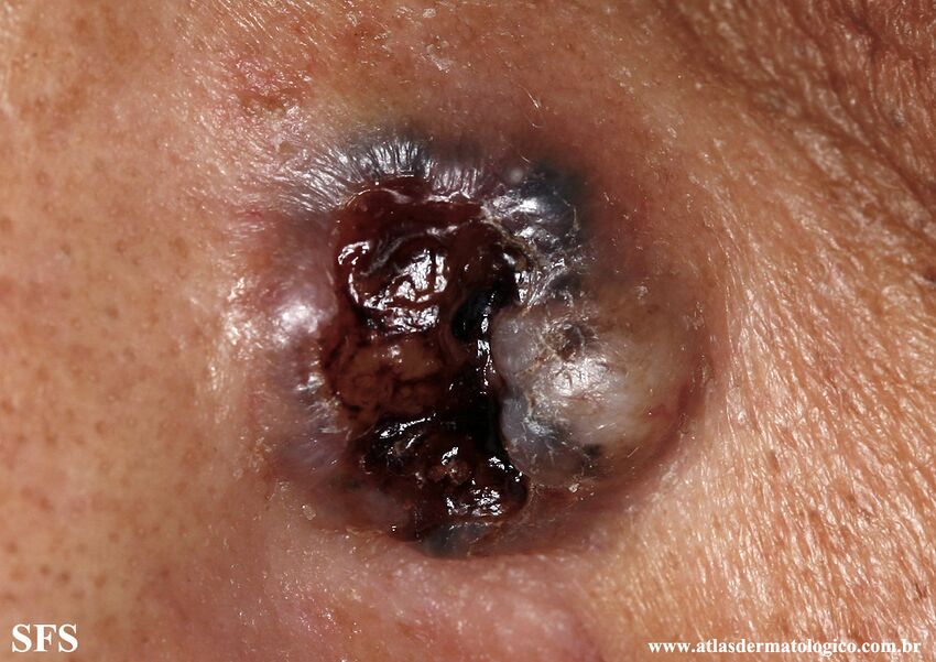 Basal Cell Carcinoma (Dermatology Atlas 334).jpg