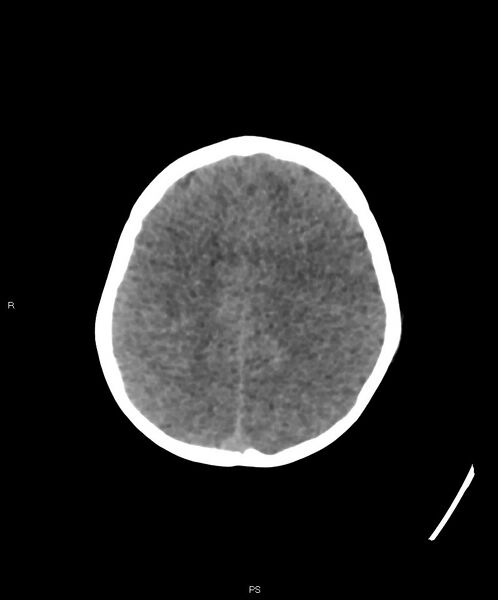 File:Basal ganglia and parenchymal ischemia (Radiopaedia 45818-50083 Axial non-contrast 10).jpg